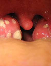 Throat Ulcer Throat Ulcer Infection