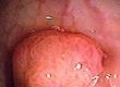 What Are Throat Polyps?