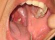 White Lumps From Throat in Mouth: What Are They?