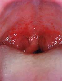 Throat Throat Infection Streptococcus