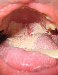Oral Thrush Thrush Fungal Infection