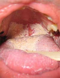 infections in adults Throat Fuerst recommend No hands swallow