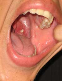 White Balls In Throat 28