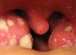 Ulcers In The Throat