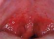Streptococcus Throat Infections