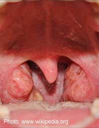 Quinsy Tonsil Tonsils Peritonsillar