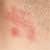 Shingles Affected My Throat: A Case Study