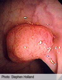 Throat Polyps Throat Polyp Throat Polyps