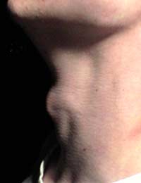 Adam’s Apple Throat Larynx Neck Thyroid