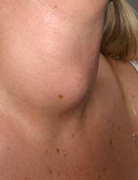 Goitre Thyroid Lump In The Throat